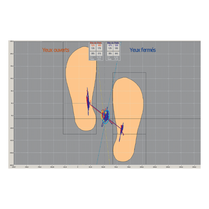 Pedana Stabilometrica Cyber-Sabots - Diagramme delle asimmetrie