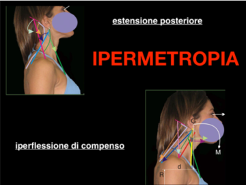 Assetto posrurale nell'ipermetrope - Sprintit Posturologia