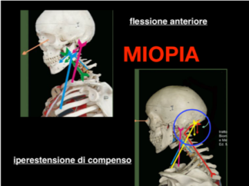 Assetto posturale nel miope - Sprintit Posturologia